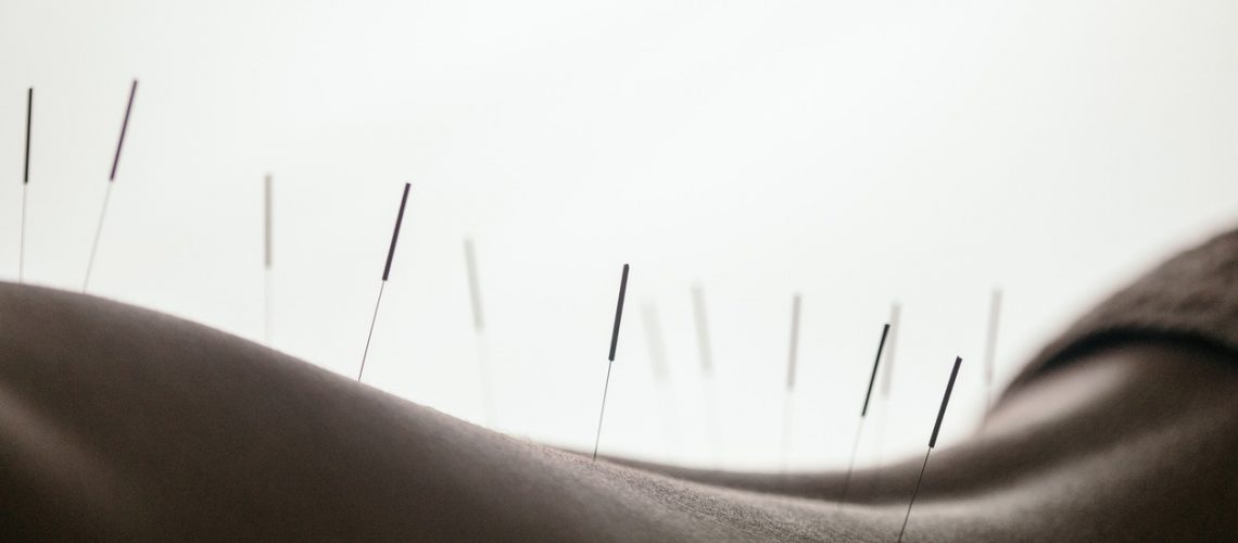 accupuncture calgary