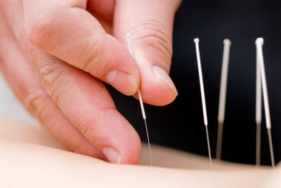 Acupuncture Needles | SW Massage Therapy & Wellness