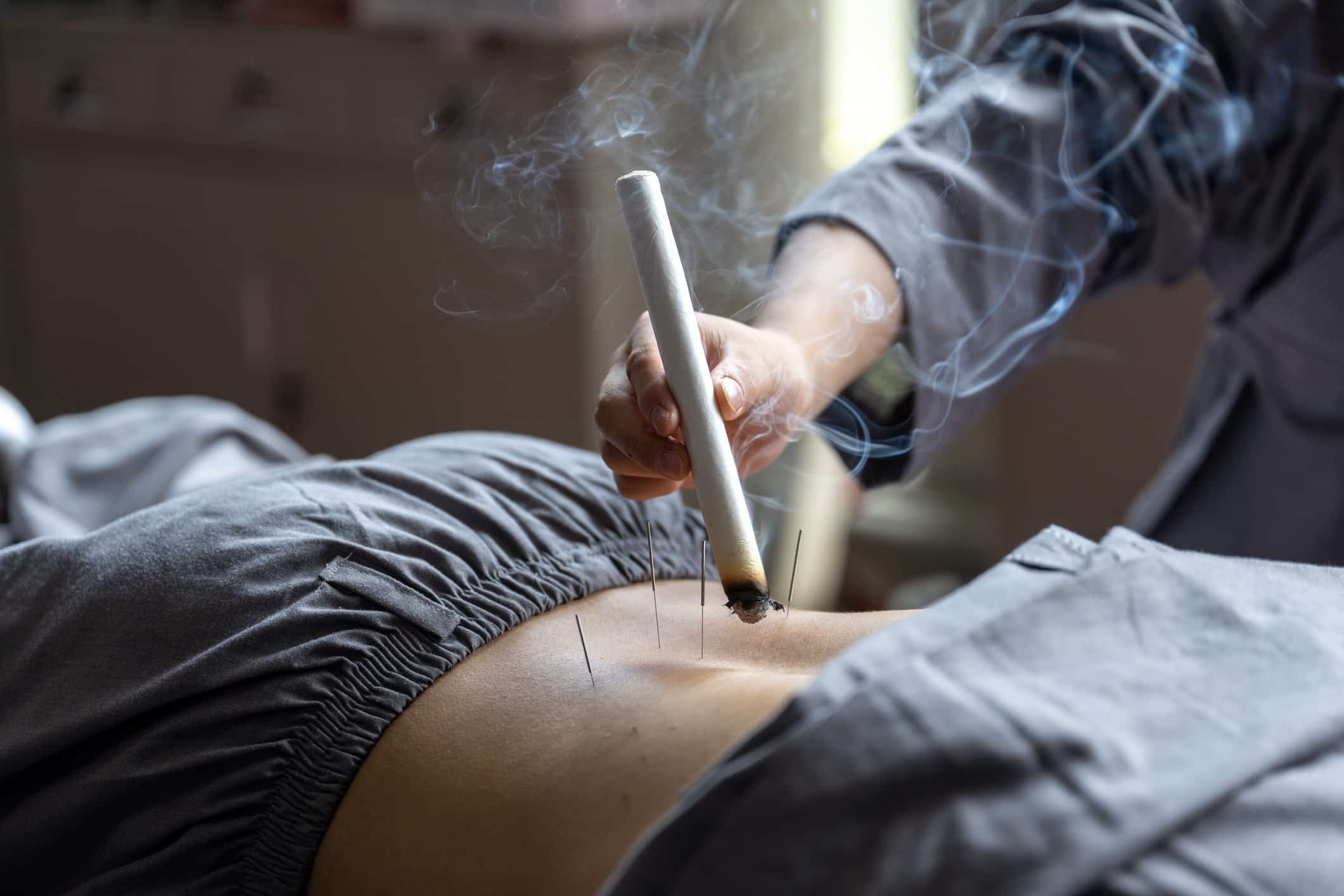 A man is doing TCM acupuncture and moxibustion and moxibustion treatment