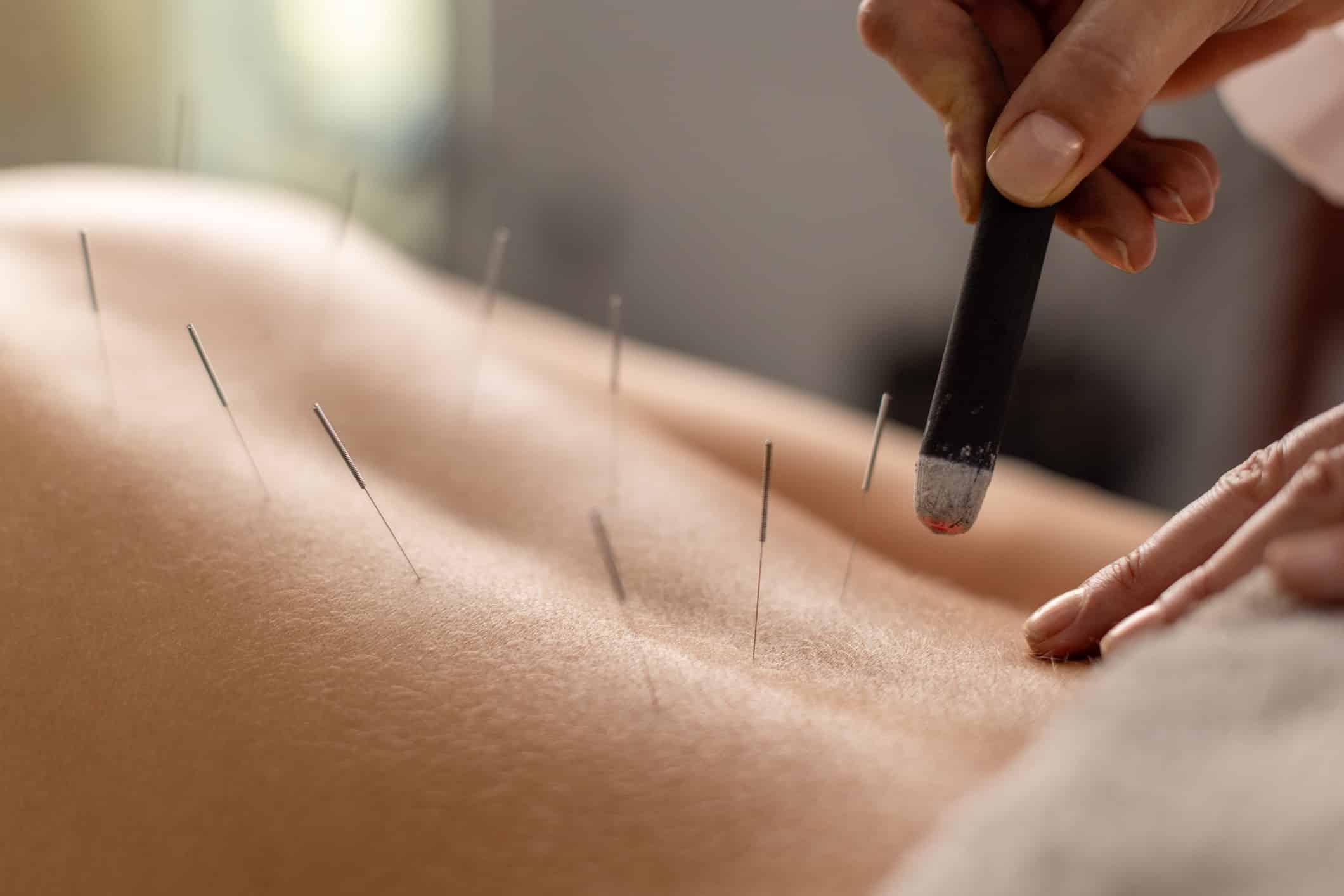Woman is lying on her stomach on an acupuncture bed, getting a treatment with acupuncture needles and moxa.